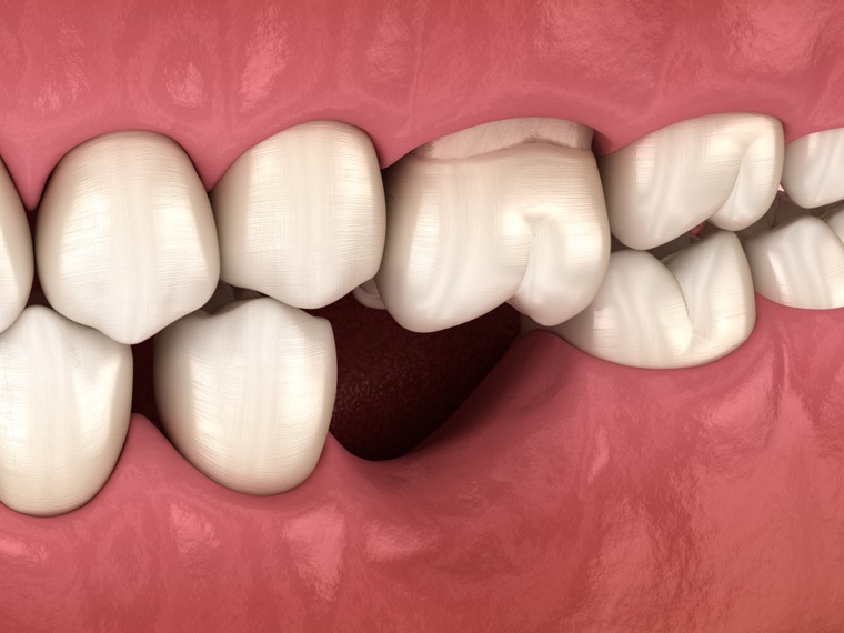 Remplacement de dents — implants