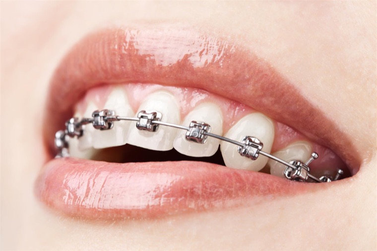 Alignement des dents — orthodontie